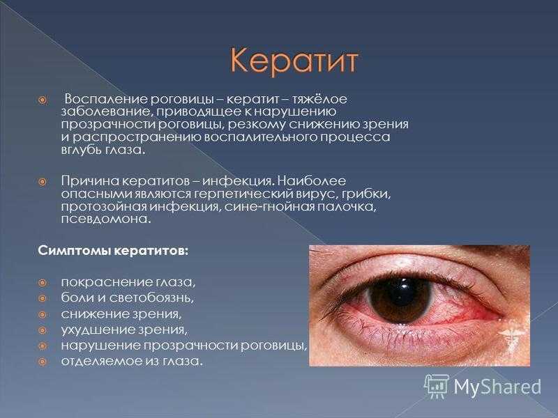 Причины кератита. лечение заболеваний глаз в ао семейный доктор