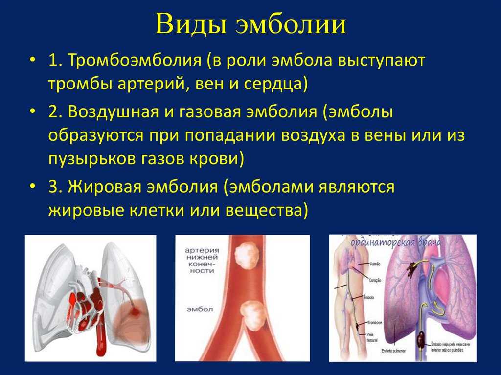 Тромбоэмболия: симптомы и признаки, причины, лечение и чем опасна