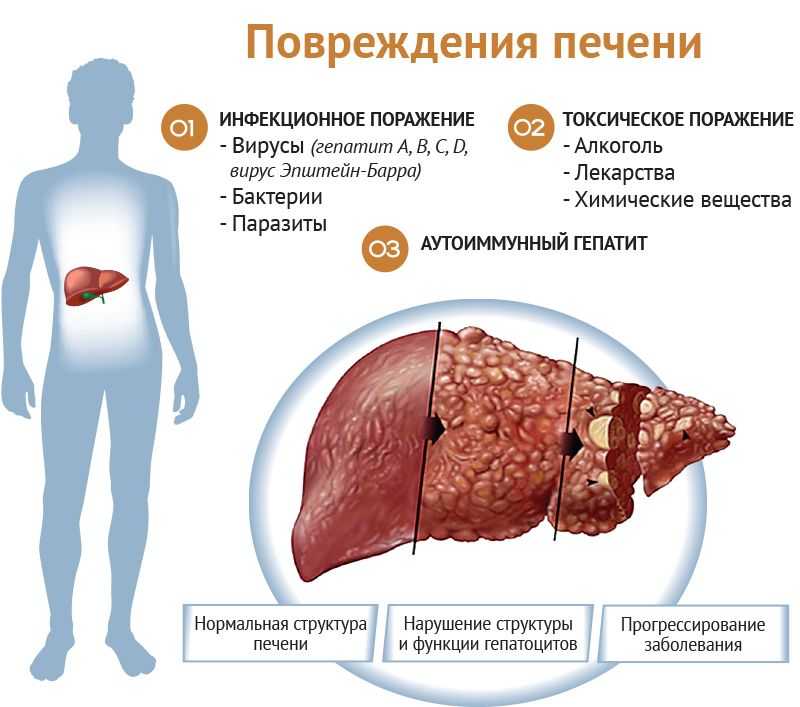 Первые признаки цирроза печени